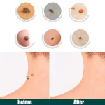 Natural Skin Tag Remover Patches - Image 5